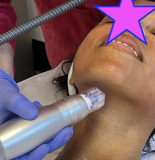 Does Microneedling With RF Really Work?