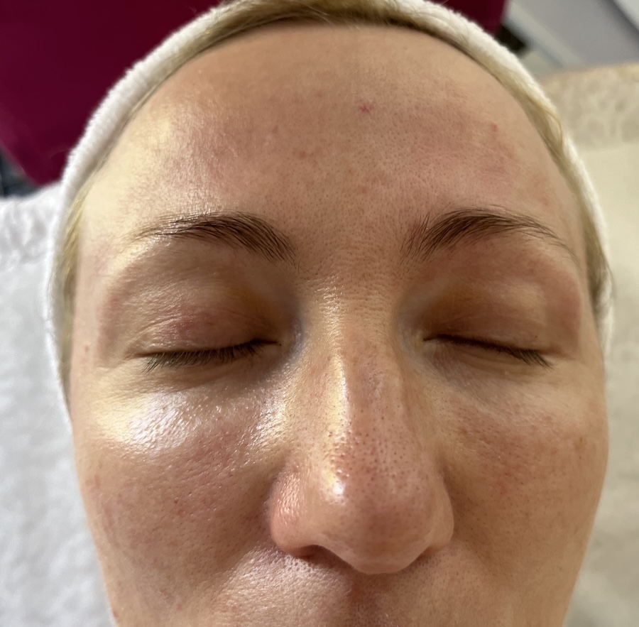 Skin lifting after RF microneedling Sylfirm X treatment