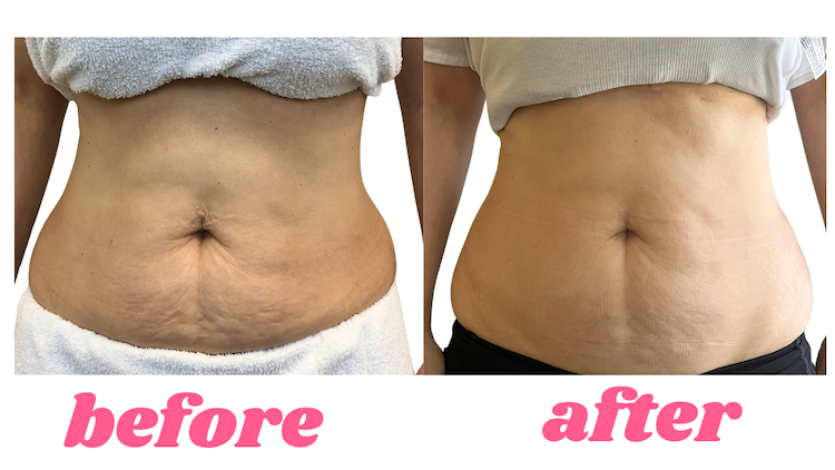 before and after endospheres and lymph drainage treatment Toronto for Weight Loss
