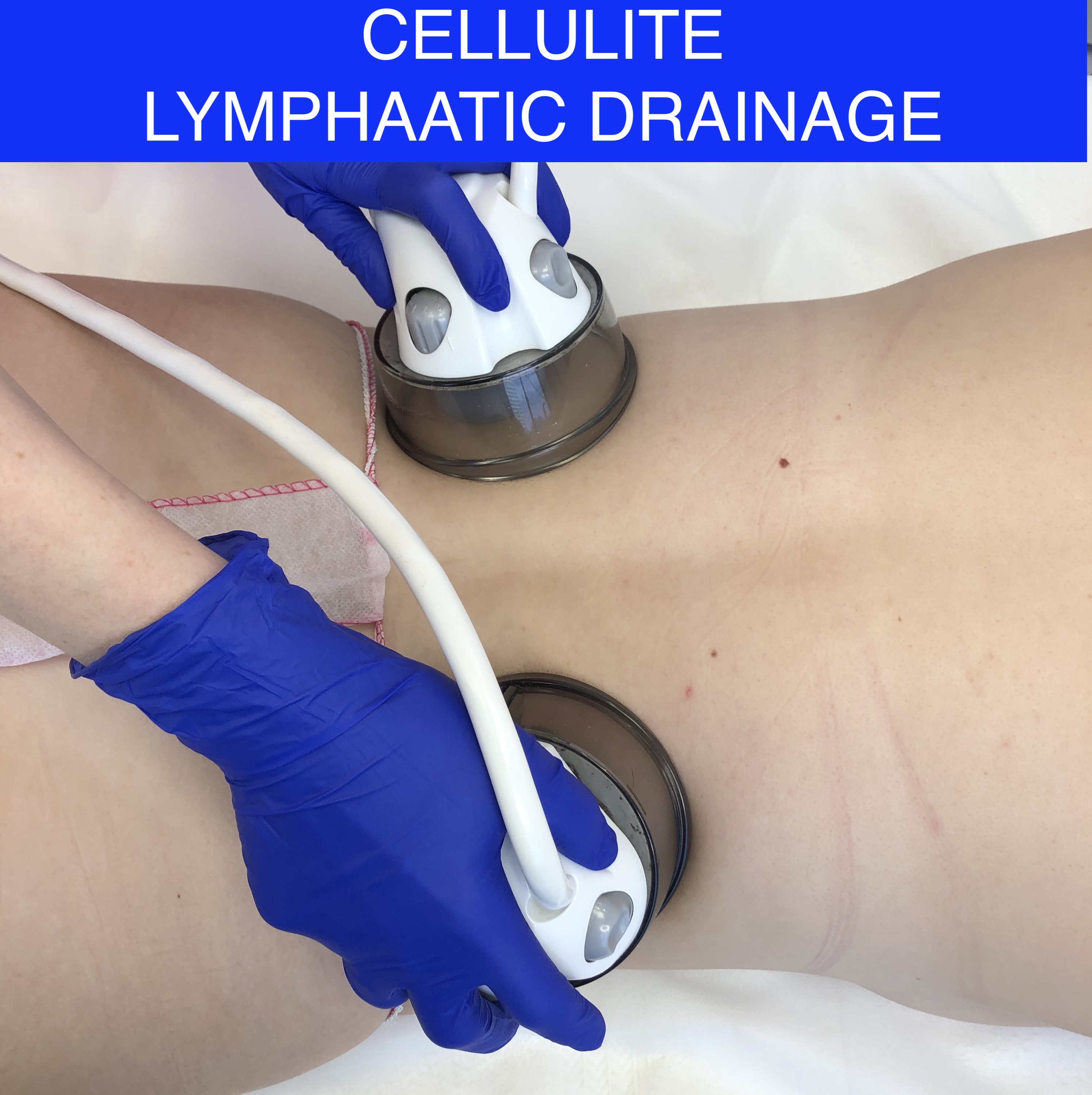 Lymphatic drainage treatment for cellulite