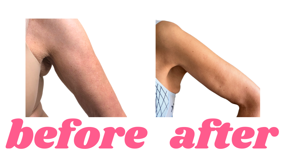 Before and after photos showing smoother arms after Endospheres Therapy in Toronto