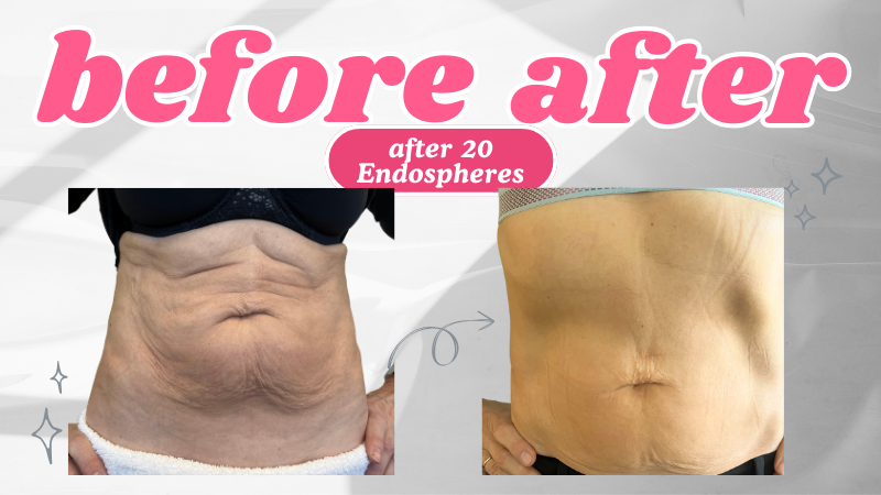 Body contouring with Endospheres Therapy – abdomen transformation