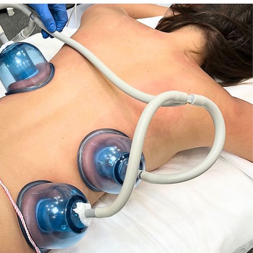 Therapist using Starvac machine on client’s back in Toronto clinic