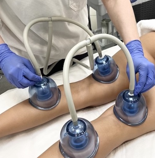 Visible results of Starvac lymphatic drainage reducing puffiness and fluid retention in the legs.