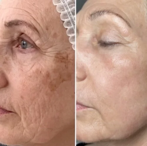 RF microneedling before and after results for mature skin