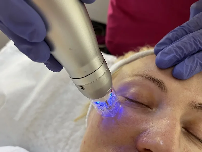 RF microneedling under eyes treatment with Sylfirm X