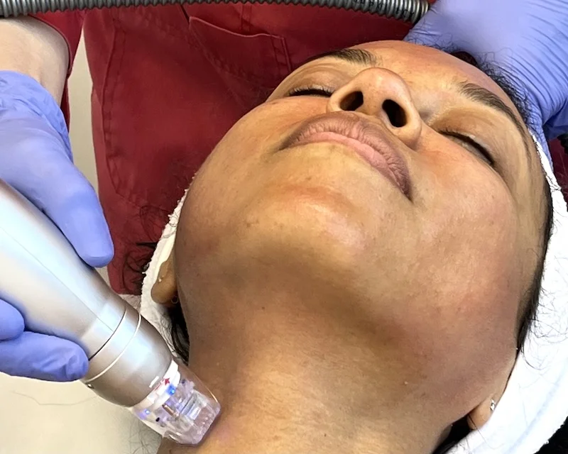RF microneedling treatment safely performed on darker skin tones in Toronto