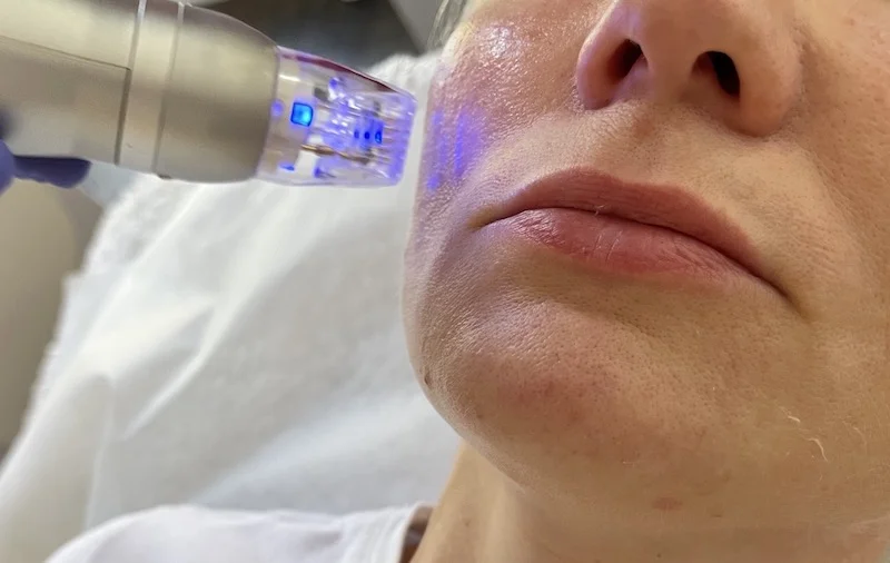 RF microneedling skin tightening treatment for mature and menopausal skin in Toronto