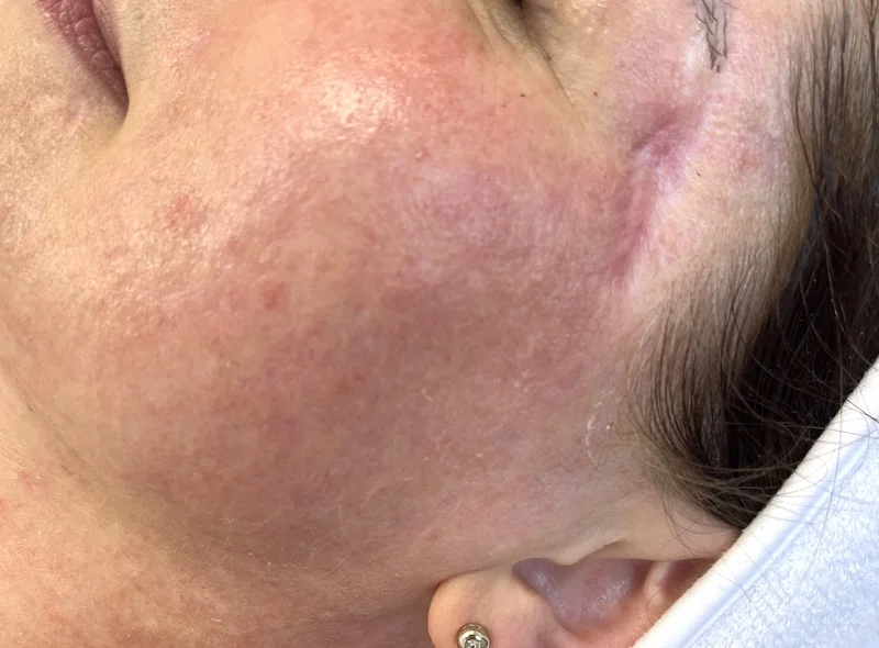 Face reddness after RF microneedling treatment