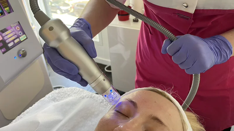 RF Microneedling Cost & Benefits in Toronto