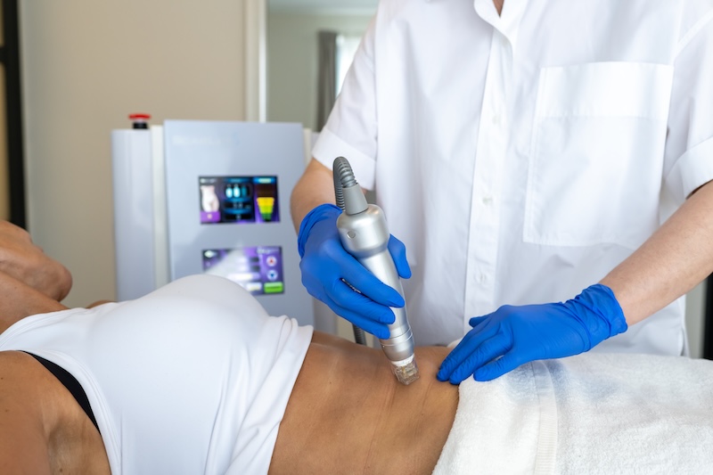 RF microneedling body Toronto