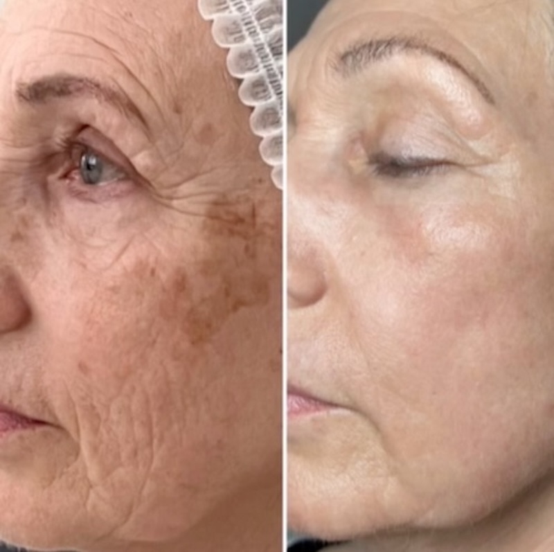 Sylfirm X Melasma and Redness Treatment – Toronto Sylfirm X treatment results for melasma and facial redness using pulsed RF technology